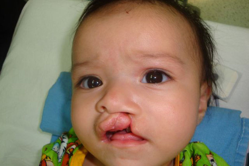 Alexa de bebé antes de la cirugía de paladar hendido