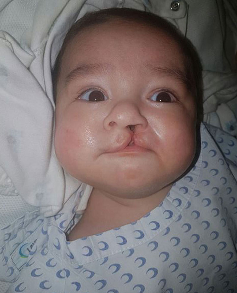 damian before cleft surgery