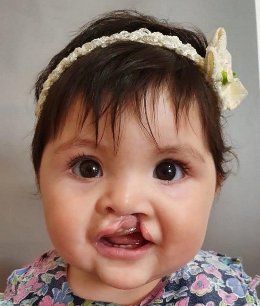 luaxana before cleft surgery