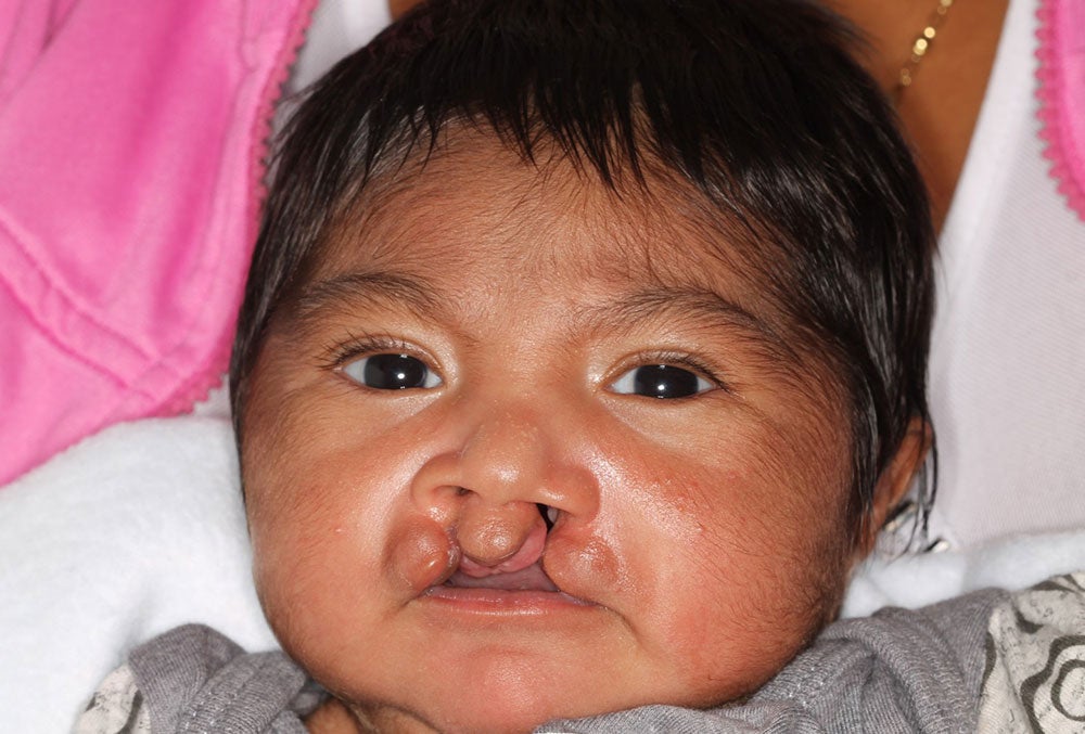 mathias before cleft surgery