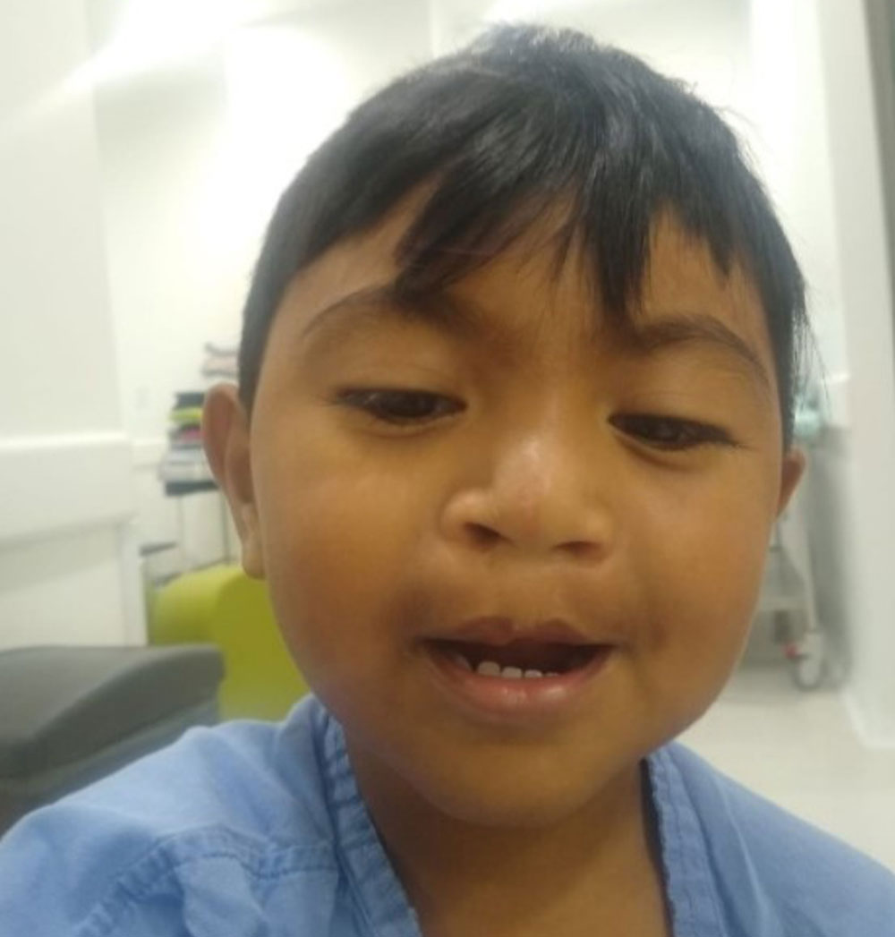 mathias just after cleft surgery at clinica noel