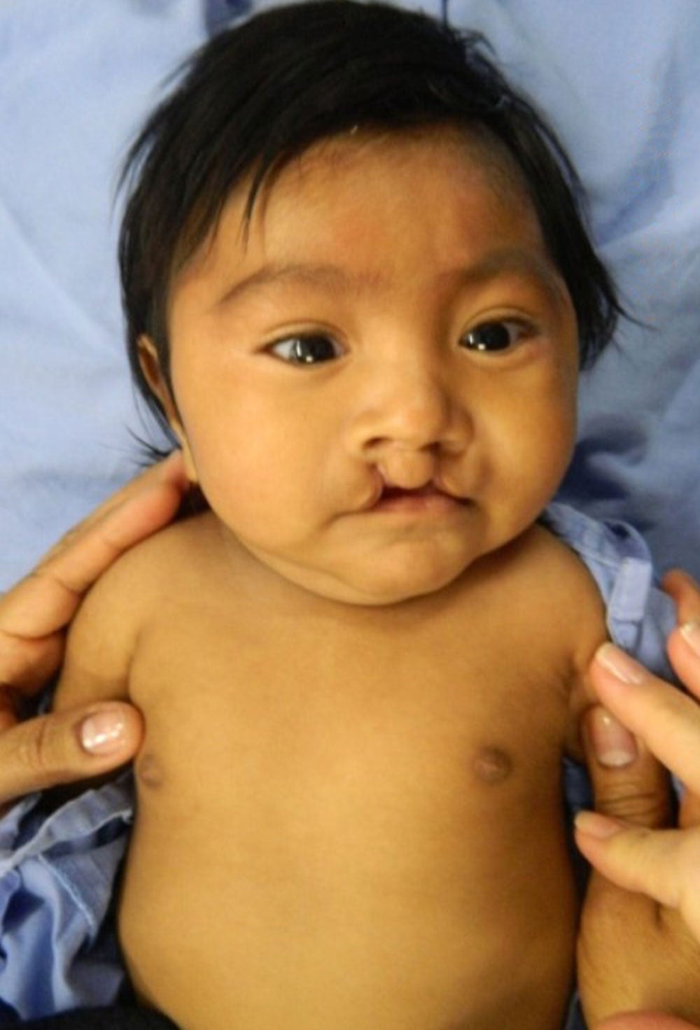 mathias in the operating room just before cleft surgery