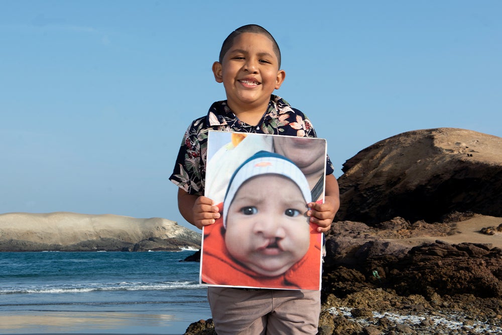 ramses before and after cleft surgery