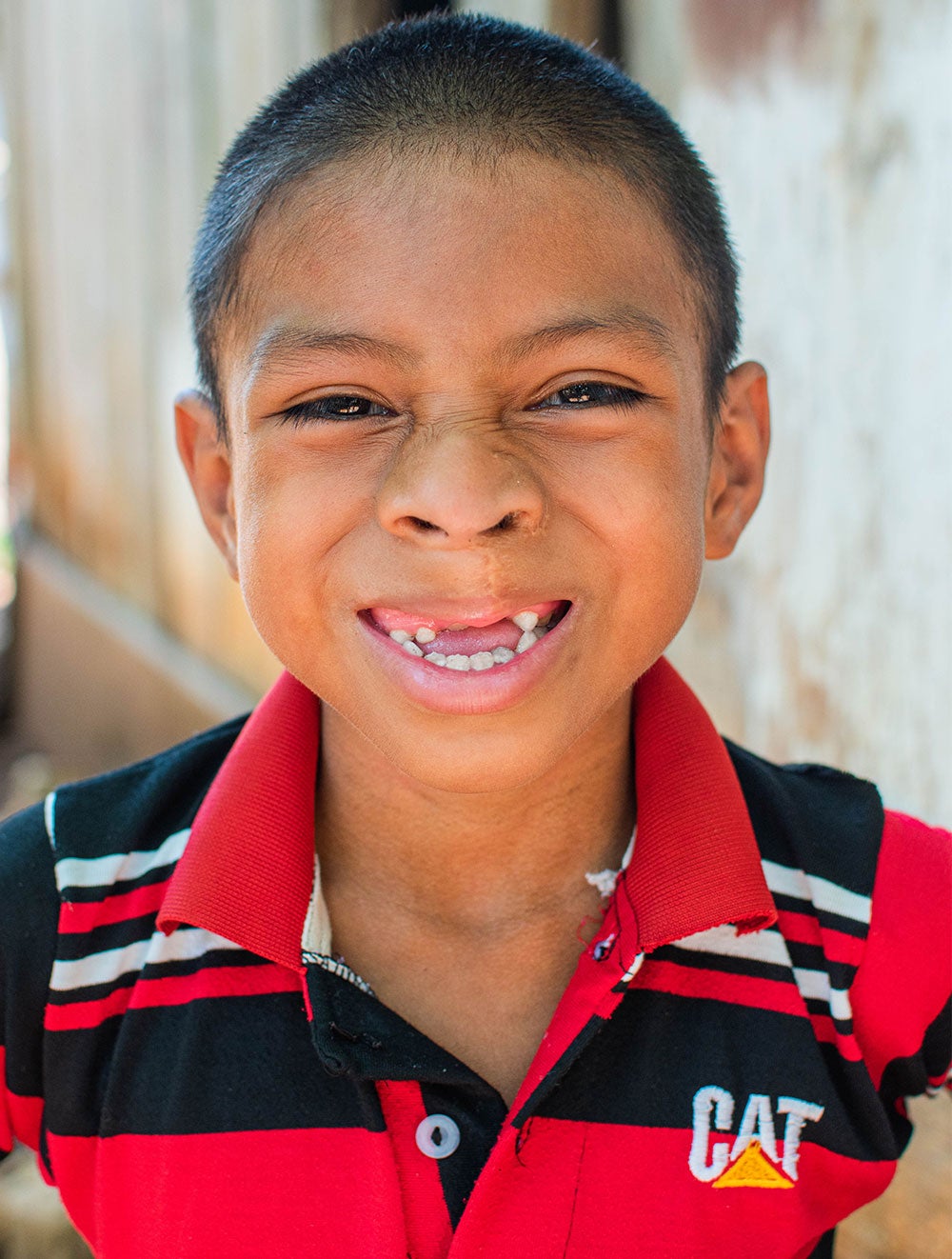 Auner smiling toothless after cleft surgery