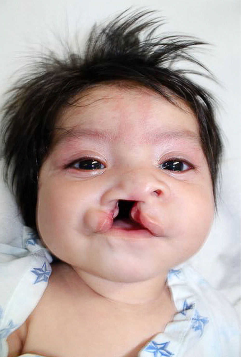 Barbara before cleft surgery