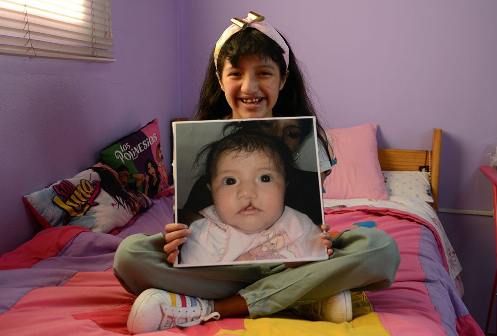 Estephany holds a picture of her before cleft surgery