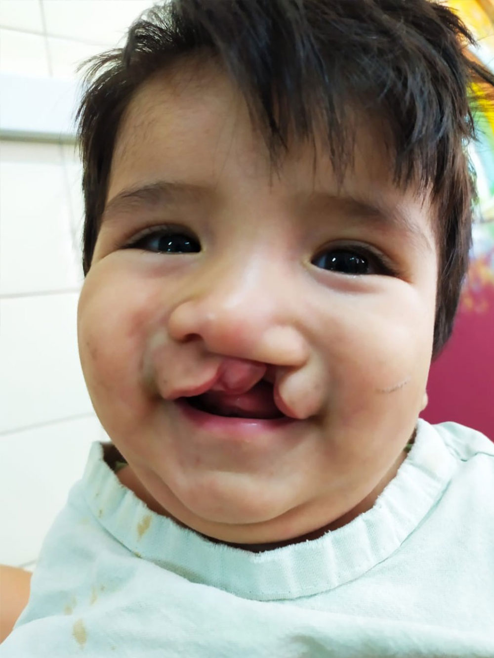 Felix smiling before cleft surgery