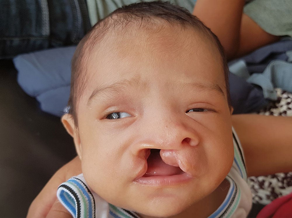 joseyur before cleft surgery