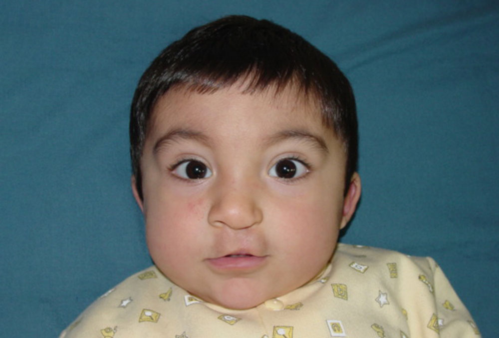 Vicente de bebé tras una operación de paladar hendido