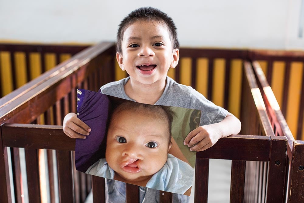 Auner holding a picture of himself before cleft surgery