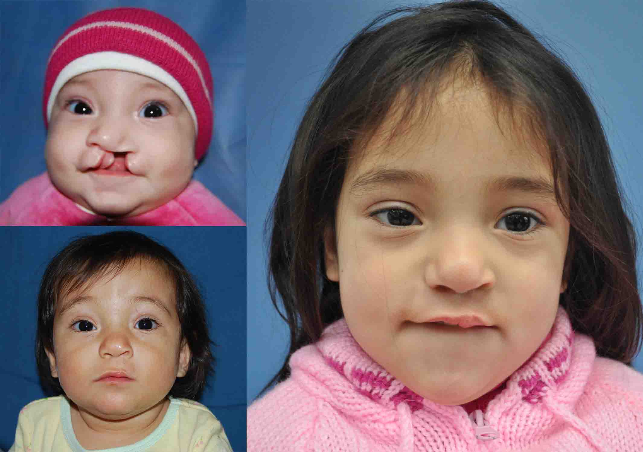 Camila antes y después de la cirugía de paladar hendido (2008 a 2017)