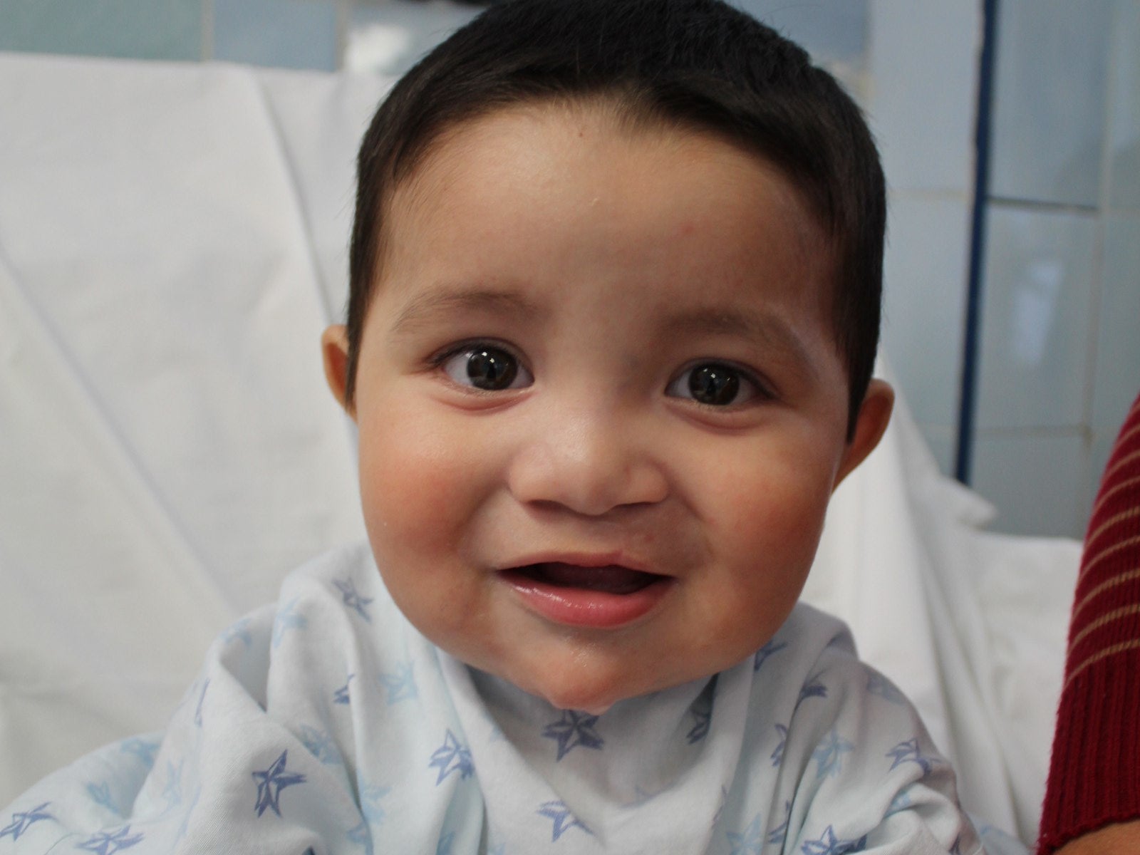 gael sonriendo después de la cirugía de labio hendido