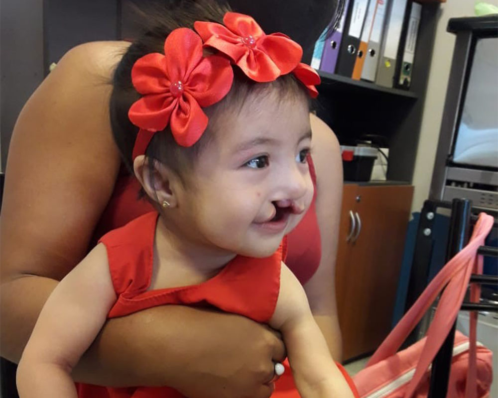 Isabella smiling as a baby, before cleft surgery