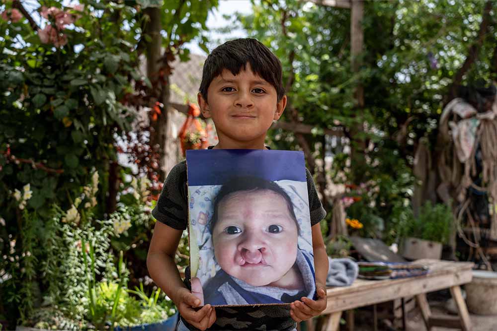 Ezequiel holds up a photo of himself from before cleft treatment