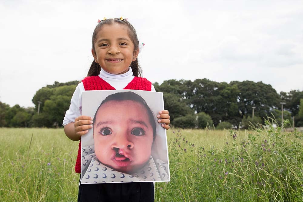 Ivanna has come so far in her cleft treatment journey