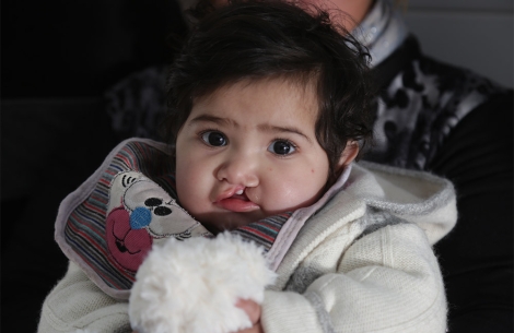 baby with a cleft lip 