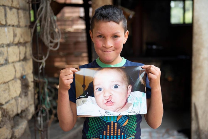 Neitan smiling and holding a picture of himself before cleft surgery