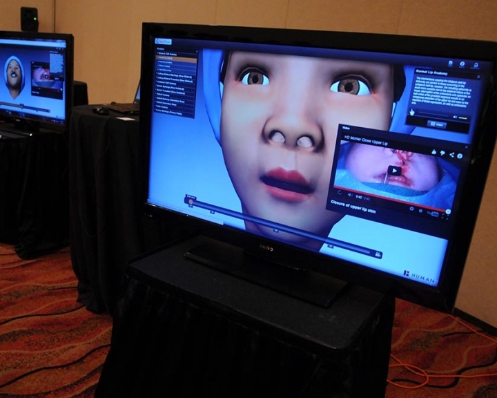 virtual cleft surgery
