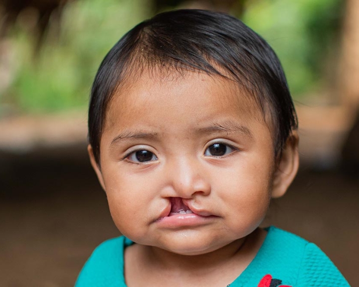 child with untreated cleft from Guatemala