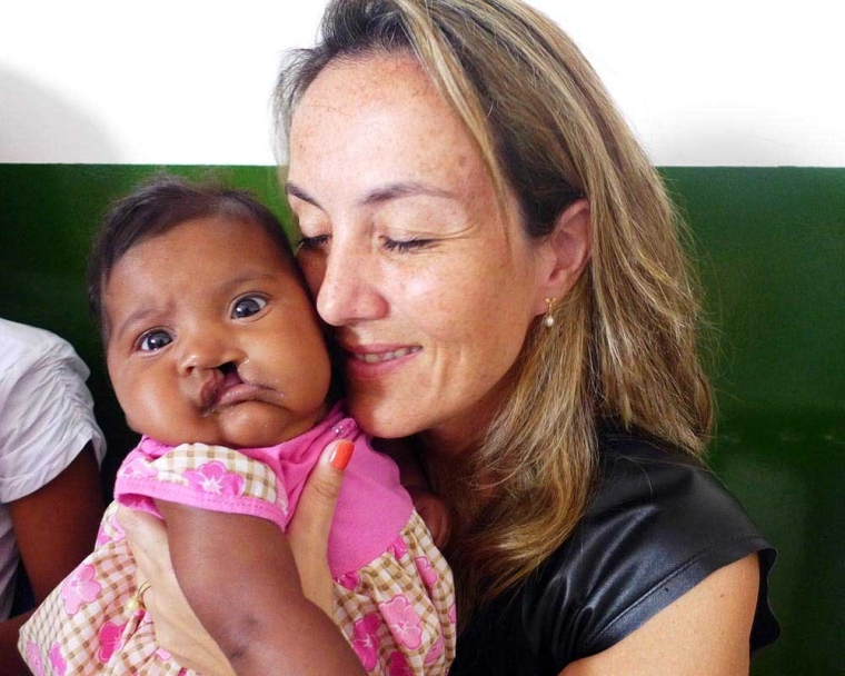 mariane holding a cleft affected baby