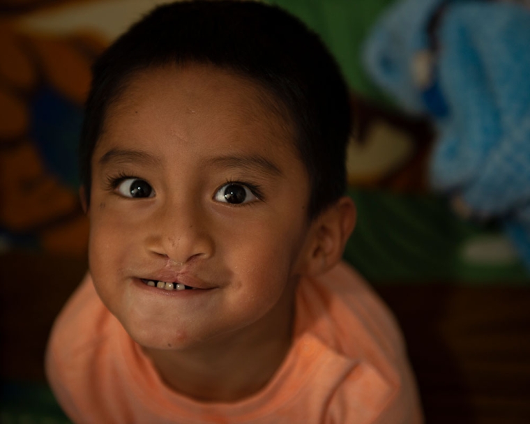 Anghelo smiling after cleft surgery