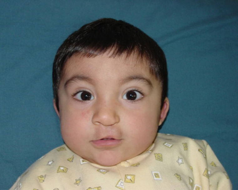 Vicente as a baby after cleft surgery