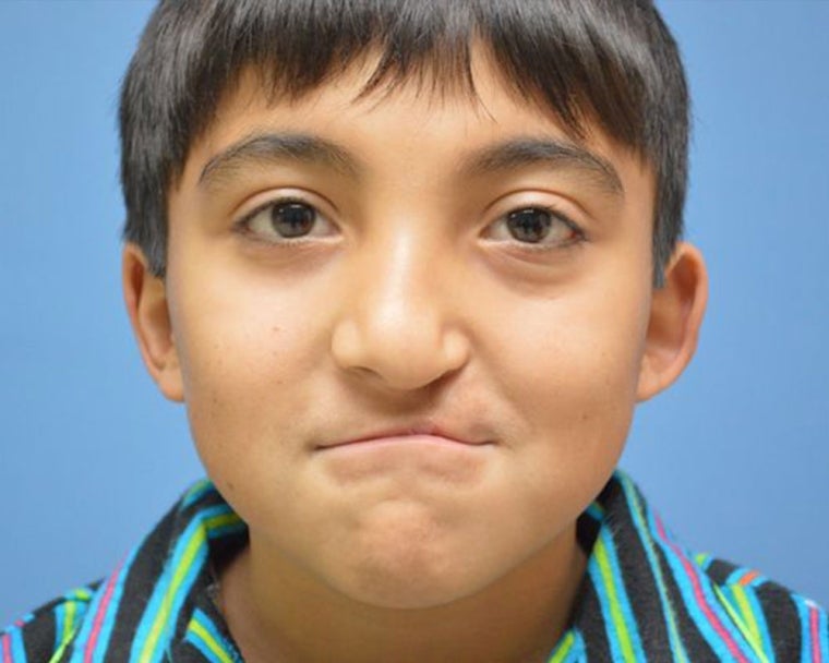 Vicente as a kid after cleft surgery