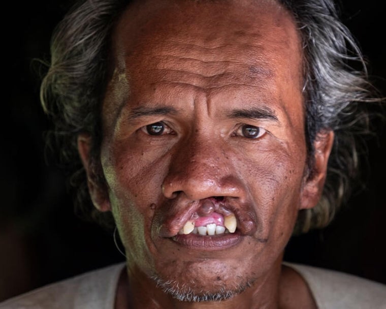 Alim antes de la cirugía