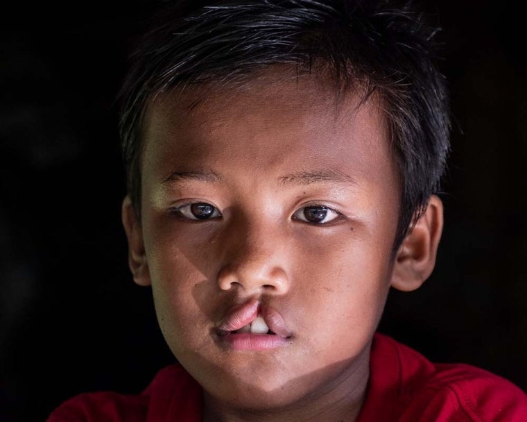 Rajib antes de la cirugía